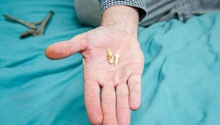 بريطاني يخلع أسنانه بنفسه والسبب كورونا