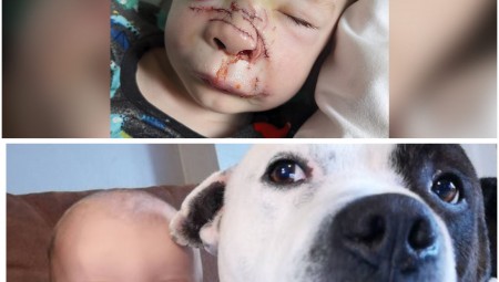 بريطانيا.. جروح مروعة يتركها كلب العائلة الأليف على وجه طفل صغير
