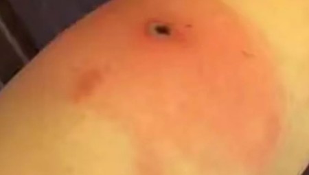 رجل يصبح أول ضحية على الإطلاق لمرض ألاسكابوكس !!