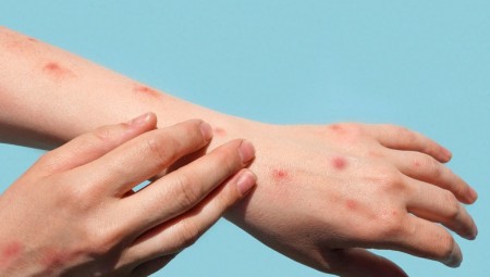 أعراض جديدة لجدري القردة... وأكثر من 2000 إصابة بالجدري في المملكة المتحدة