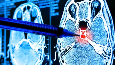الولايات المتحدة توافق على عقار يعالج الزهايمر في مراحله الأولى