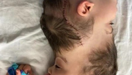 استخدام تقنية الواضع الافتراضي في عملية لفصل توأمين برازيليين ملتصقي الرأس