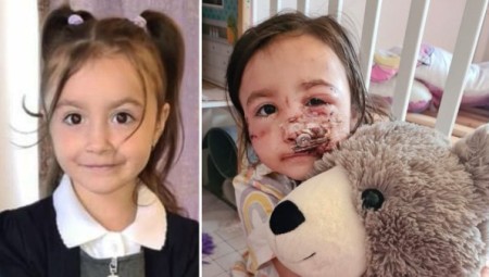 طفلة بريطانية تتعرض لهجوم شرس من قبل كلب الجيران يفقدها وجنتها