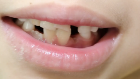 أم تستخدم الكماشة لخلع أسنان ابنتها بسبب عدم قدرتها الحصول على موعد طبيب NHS