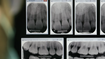 إنجلترا تزيد حوافز أطباء الأسنان لتسهيل مواعيد الطوارئ ضمن NHS